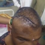 थाना चीचली के अंतर्गत मामूली विवाद के चलते देवर ने भाभी के सर में मारी कुल्हाड़ी गंभीर रूप से घायल