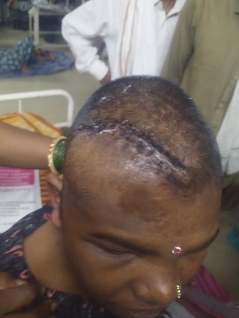 थाना चीचली के अंतर्गत मामूली विवाद के चलते देवर ने भाभी के सर में मारी कुल्हाड़ी गंभीर रूप से घायल - नरसिंहपुर, मध्य प्रदेश